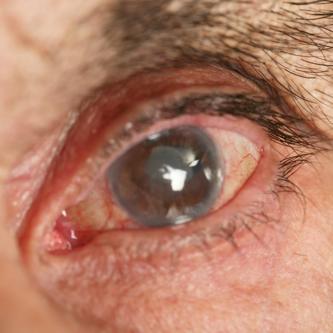 Pressão Intraocular Elevada